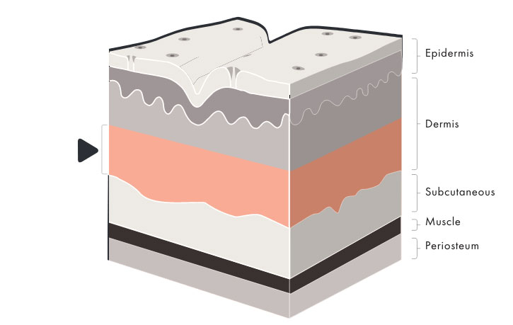 Cross-section of parts of the skin to illustrate the depth of Versa filler injections at the dermis.