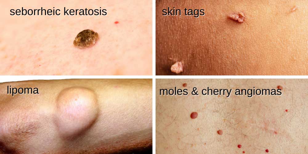 Four close up images of seborrheic keratosis, skin tags, lipoma, moles and cherry angiomas on the skin.